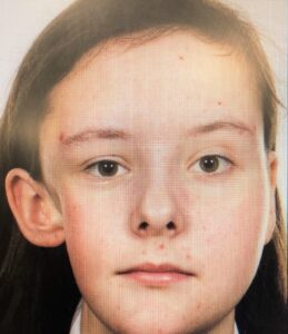 facial asymmetry